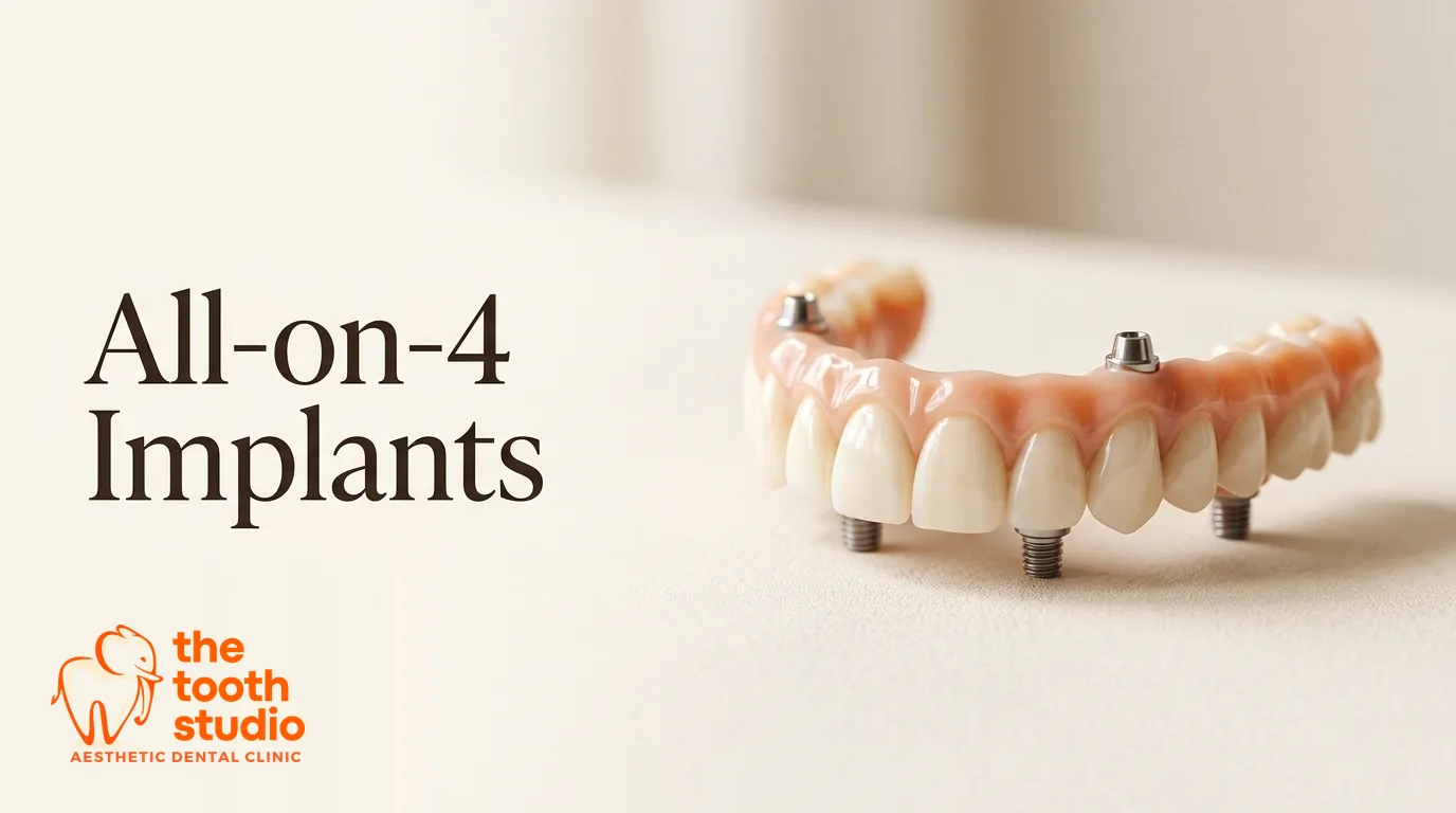 All-on-4 Dental Implants: A Full Arch on Four Implants - The Tooth Studio, Kukatpally Hyderabad