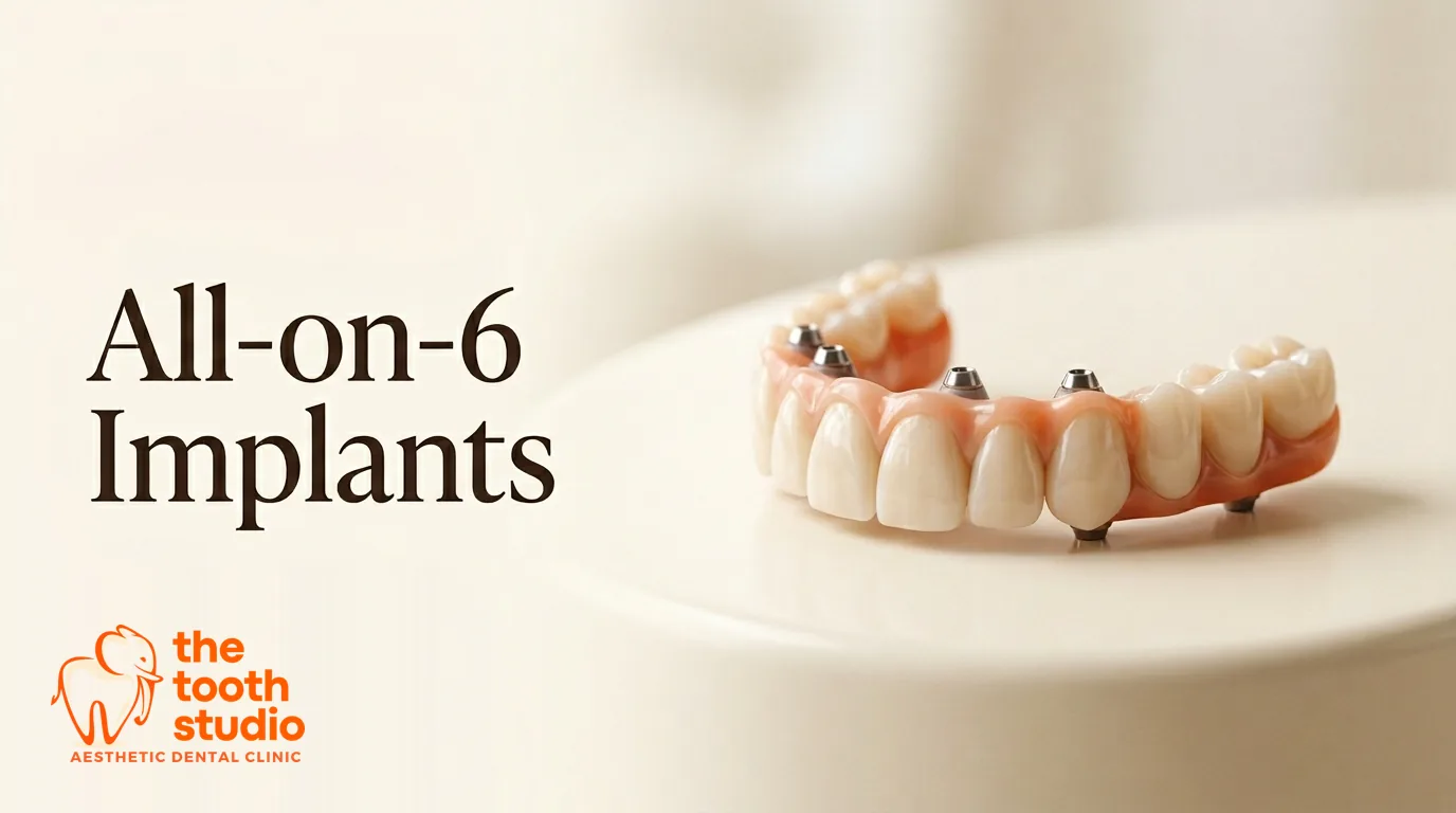 All-on-6 Dental Implants: More Support for a Full Arch - The Tooth Studio, Kukatpally Hyderabad