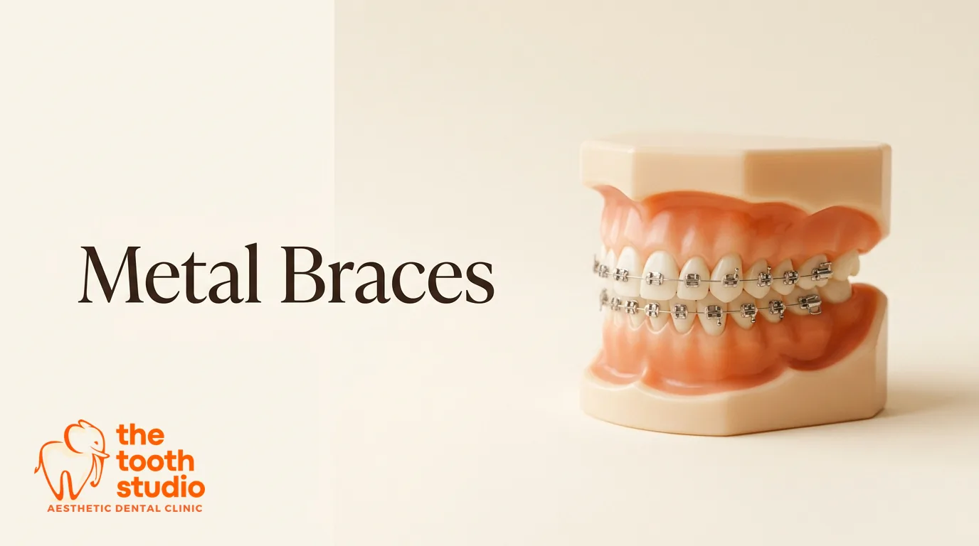 Metal Braces: Cost, Process and What to Expect - The Tooth Studio, Kukatpally Hyderabad