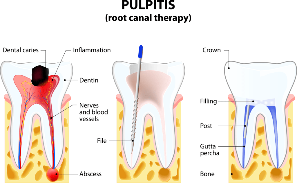 root canal treatment