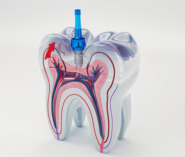root canal treatment