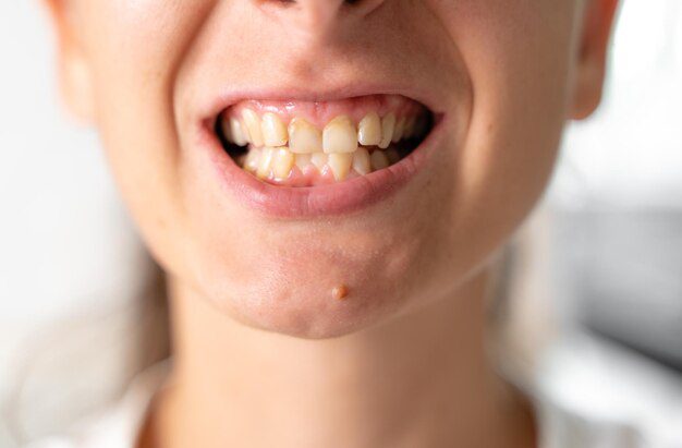 Stained Teeth