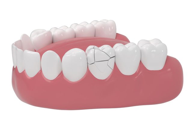 Cracked Tooth