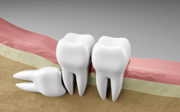 Impacted Teeth - Common Dental Problems
