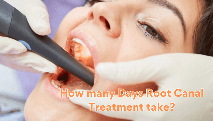 How many Days Root Canal Treatment