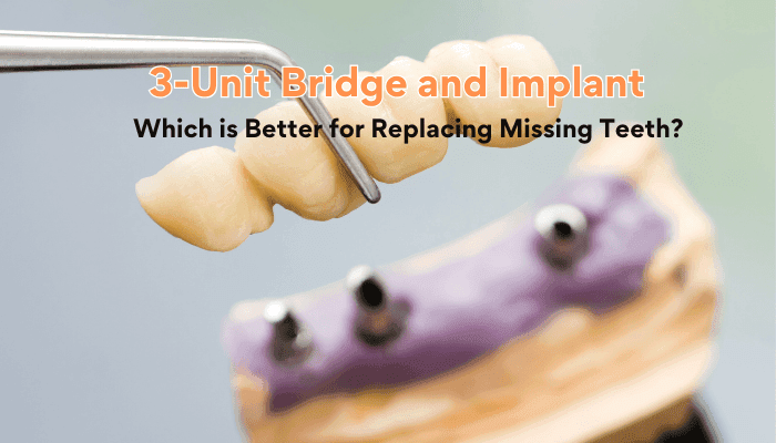 3-Unit Bridge and Implant